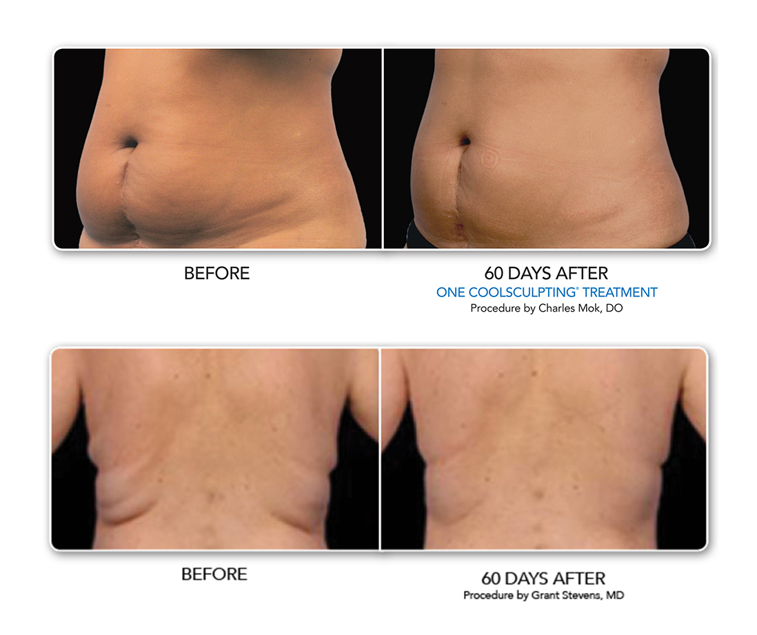 Westchester County, NY - Nonsurgical Fat Removal