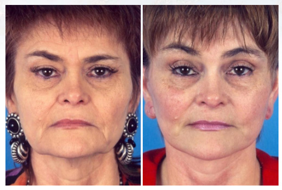 Facelift Surgery Westchester County